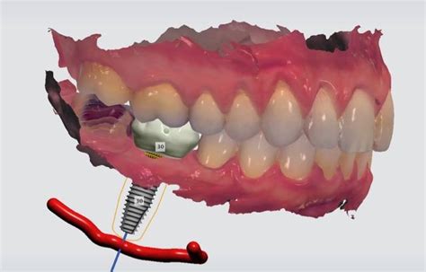 Digital Workflow In Implantology Vitadent Clinic Private Dentists