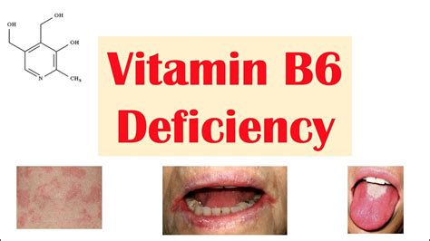 Vitamin B6 Pyridoxine Deficiency Dietary Sources Causes Signs