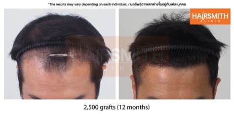 Hair Transplant Precautions What You Need To Know