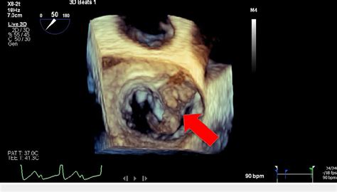 Figure 2 From Triple Valve Endocarditis With Aortic Root Abscess