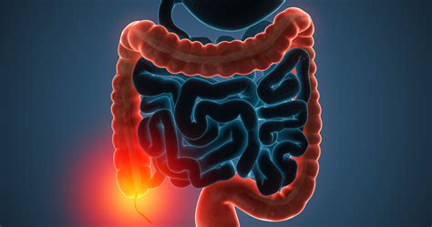 As most colon cancer begins as precancerous polyps (called adenomas) detecting and removing these polyps are key to preventing cancer. Why You Shouldn't Wait to Get a Colonoscopy | Mission ...