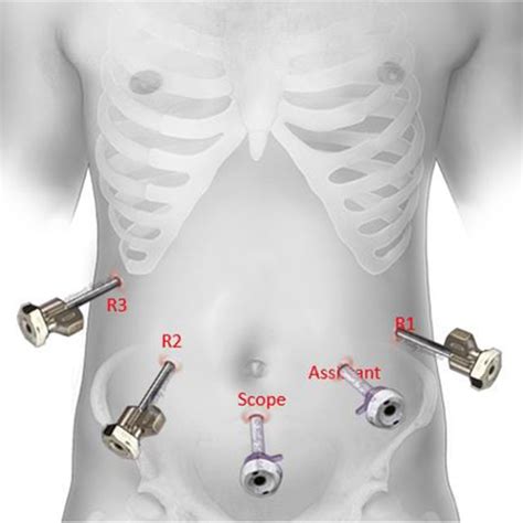 Robotic Port Placement For RDP Scope Mm Trocar For Camera Download Scientific Diagram