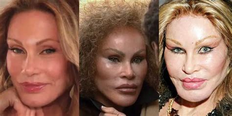 Ruined By Plastic Surgery Before And After