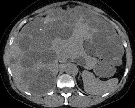 Learn more about causes, risks, symptoms,diagnosis, and incidence. Liver Atlas: Case 46: Cyst: Polycystic liver disease (PCLD)