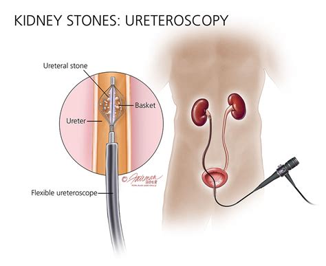 How Is Upper Urinary Tract Cancer Treated Urology Care Foundation