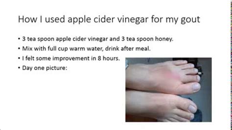 Apple Cider Vinegar For My Gout Treatment Youtube