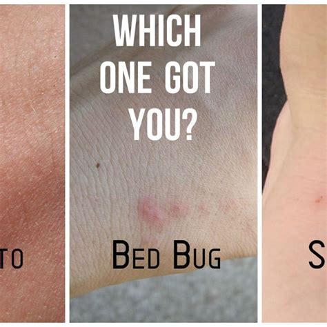 How To Diagnose Bed Bug Bites Pdf Allergic Reactions And Dermatitis