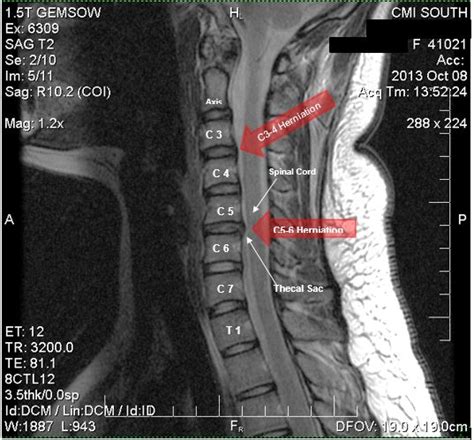 Herniated Disc Settlements From Car Accidents And More