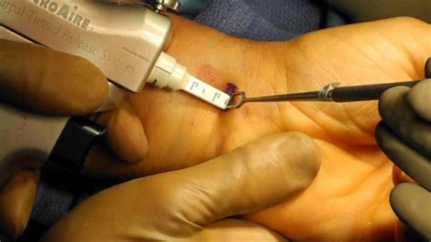 What is carpal tunnel syndrome? Endoscopic Carpal Tunnel Release Surgery Performed by Dr ...