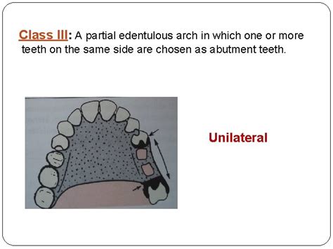 Classification Of Partially Edentulous Arches Requirements Of An