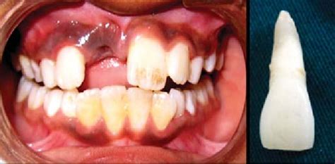 Avulsed Tooth Dental Trauma Guide Avulsed Tooth