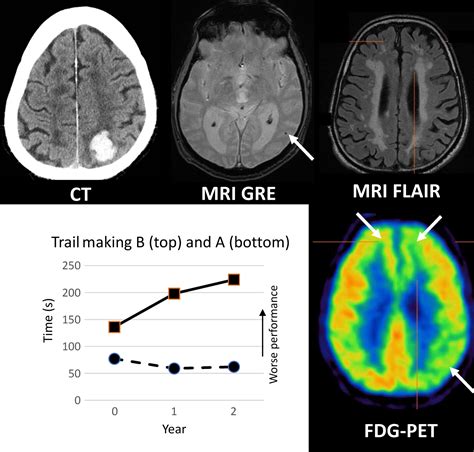 Cerebral Amyloid Angiopathy As A Cause Of Neurodegeneration Smith