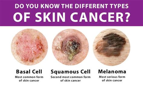 Most Common Type Of Skin Cancer Lance Embry