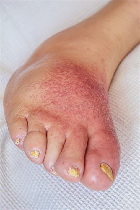 Erysipelas Of The Legs Red Rash On The Lective Focus Stock