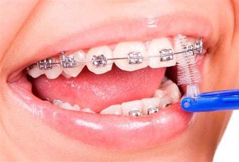 aparelho de dente preco consulta ideal
