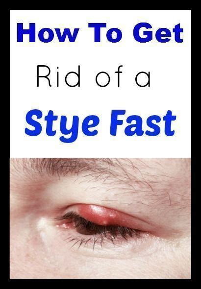 How To Treat A Stye In The Eye Under Eyelid Avoid Popping Stye