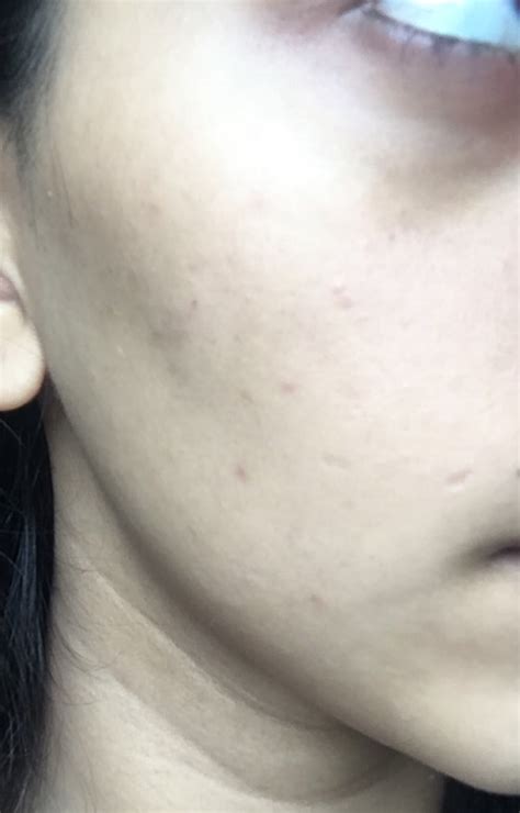 How Can I Get Rid Of Tiny Bumps Covering My Face General Acne