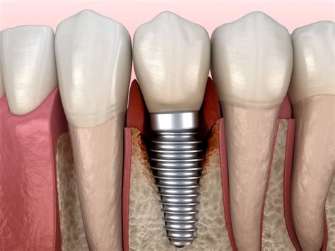 Dental Implants Gum Disease Jacksonville Dental Specialists