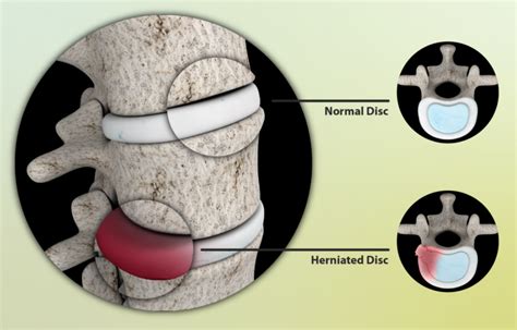 What Is The Difference Between A Bulging And Herniated