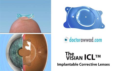 Implantable Collamer Lenses Dr Shady Awwad Eye Surgeon At Aubmc