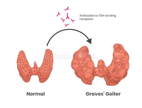 Grave`s Disease Cause Antithyroid Antibodies Stock Vector