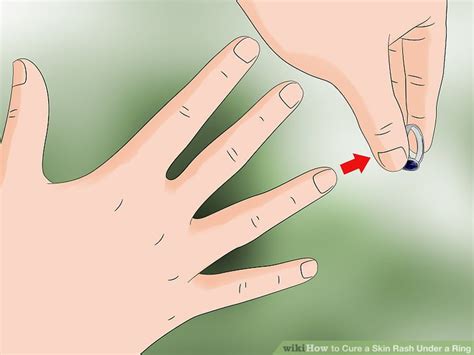 3 Ways To Cure A Skin Rash Under A Ring Wikihow