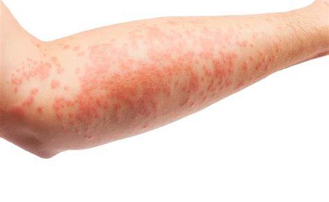 Medical News Today Common Skin Rashes Pictures Causes And