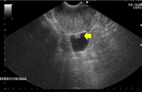 Cysts In Uterus Ultrasound