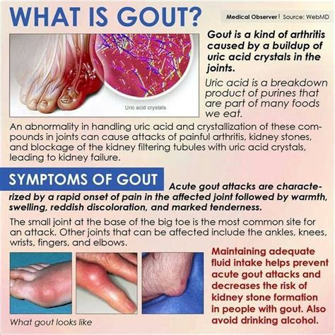 A Little Info For Everyone About Gout And Its Symptoms Gout Gout