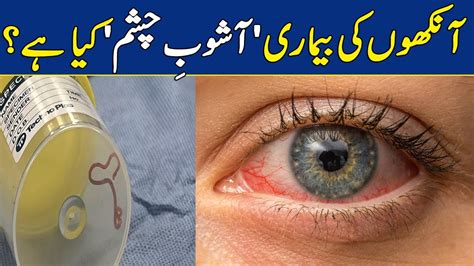 Contagious Eye Virus Conjunctivitis Spreading In Karachi Dawn News