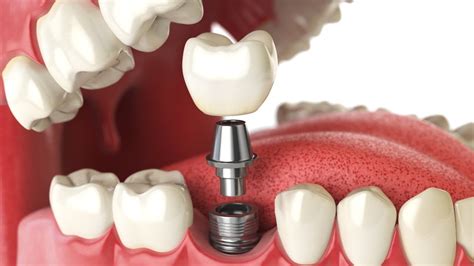 Titanium (ti) is a soft, ductile, silvery gray metal with a melting point of 1,675 °c (3,047 °f). Titanium Dental Implants: Why They are Superior | Dental ...