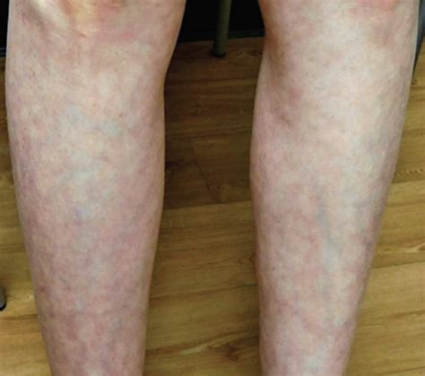 What Is The Cause Of This Patients Leg Discoloration The Dermatologist