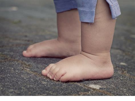 Pioneer Podiatry Portal Flat Feet In Kids