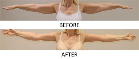 Arm Lift Before And After The Karri Clinic
