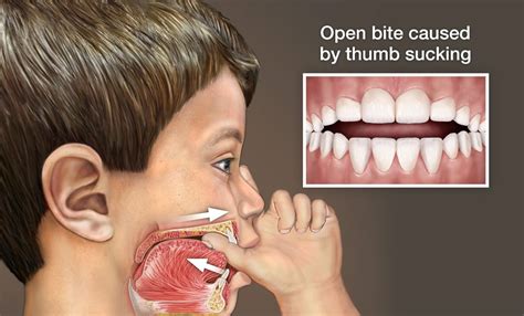 Thumb Sucking And Pacifier Use World Pediatric Dental