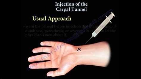 Carpal Tunnel Injection Everything You Need To Know Dr Nabil