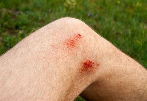 Royalty Free Scraped Knee Pictures Images And Stock Photos Istock