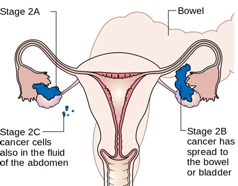 Difference Between Ovarian Cyst And Ovarian Cancer Difference Between