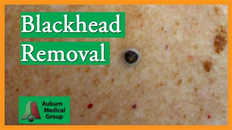 Large Blackhead Removal Without Extractor Tool Auburn Medical Group