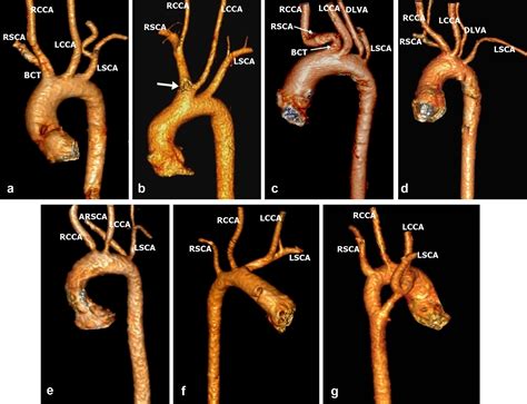 Prevalence And Types Of Aortic Arch Variants And Anomalies In
