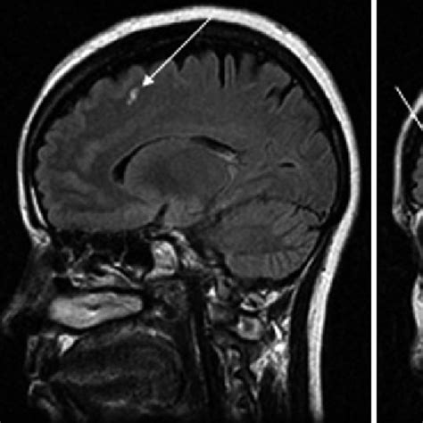 Brain Mri Showing Lesions