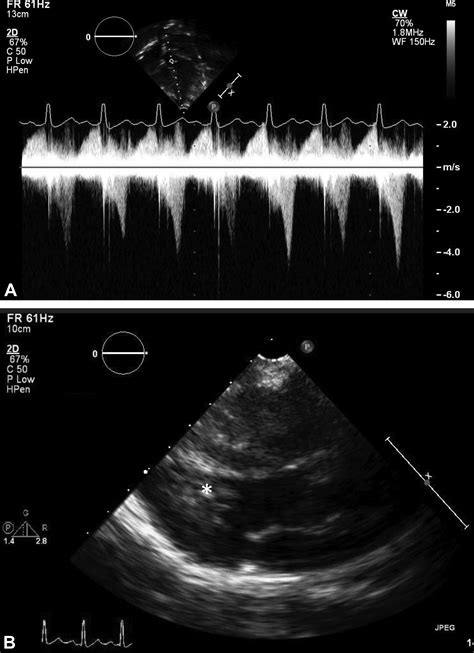 Elevated Left Ventricular Outflow Tract Velocities On Exercise Stress
