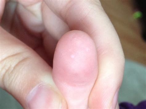 White Bumps On Fingertips And Toes Babycenter