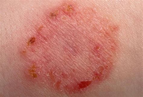 Erupção Cutânea Vermelha E Pruriginosa