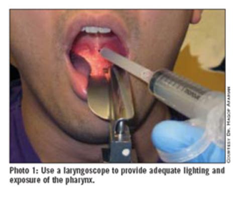 Owning The Peritonsillar Abscess — Em Curious