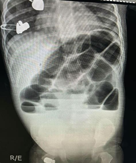 X‐ray Of The Abdomen With Multiple Air‐fluid Level Suggestive Of Small