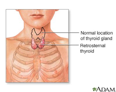 Retrosternal Thyroid Surgery Information Mount Sinai New York