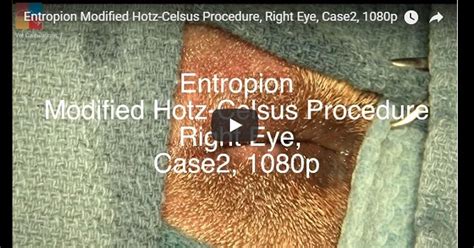 'the doctor made an incision on the top of. Entropion Modified Hotz-Celsus Procedure, Right Eye Video ...