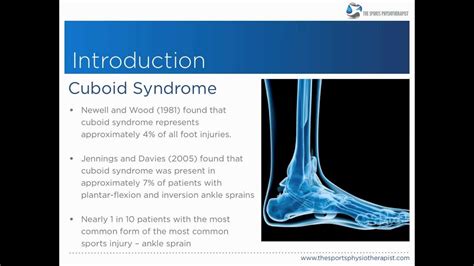 Cuboid Syndrome Diagnosis And Management Youtube