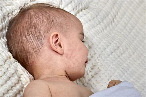 Viral Rashes In Babies Types Pictures Diagnosis Treatment